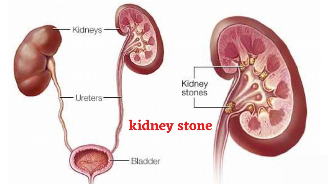 What is kidney stone, types, symptoms and treatment