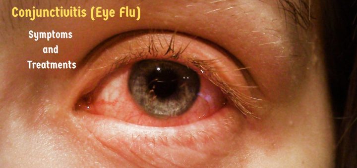 Conjunctivitis : Eye Flu Reasons, Symptoms and Treatments