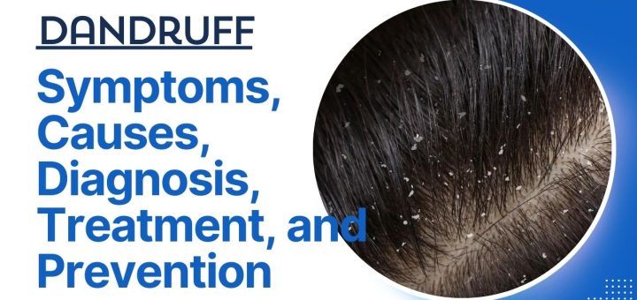 Dandruff: Symptoms, Causes, Diagnosis, Treatment, and Prevention